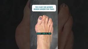 Video post by @thebunionking on YouTube