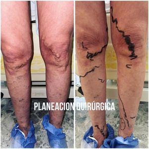 Image post by @dr.vicentevascular on Instagram