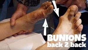 Video post by @The Bunion King on YouTube