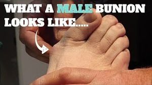 Video post by @thebunionking on YouTube