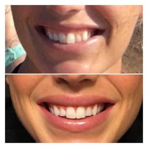 Image post by @smiledirectclub on Instagram