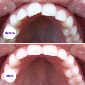 Image post by @smiledirectclub on Instagram