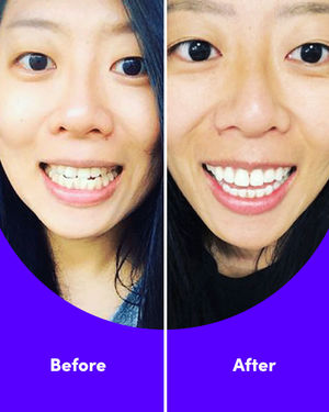 Image post by @smiledirectclub on Instagram