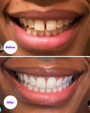 Image post by @smiledirectclub on Instagram