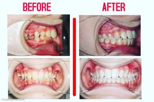 Image post by @new_smile_ortho on Instagram